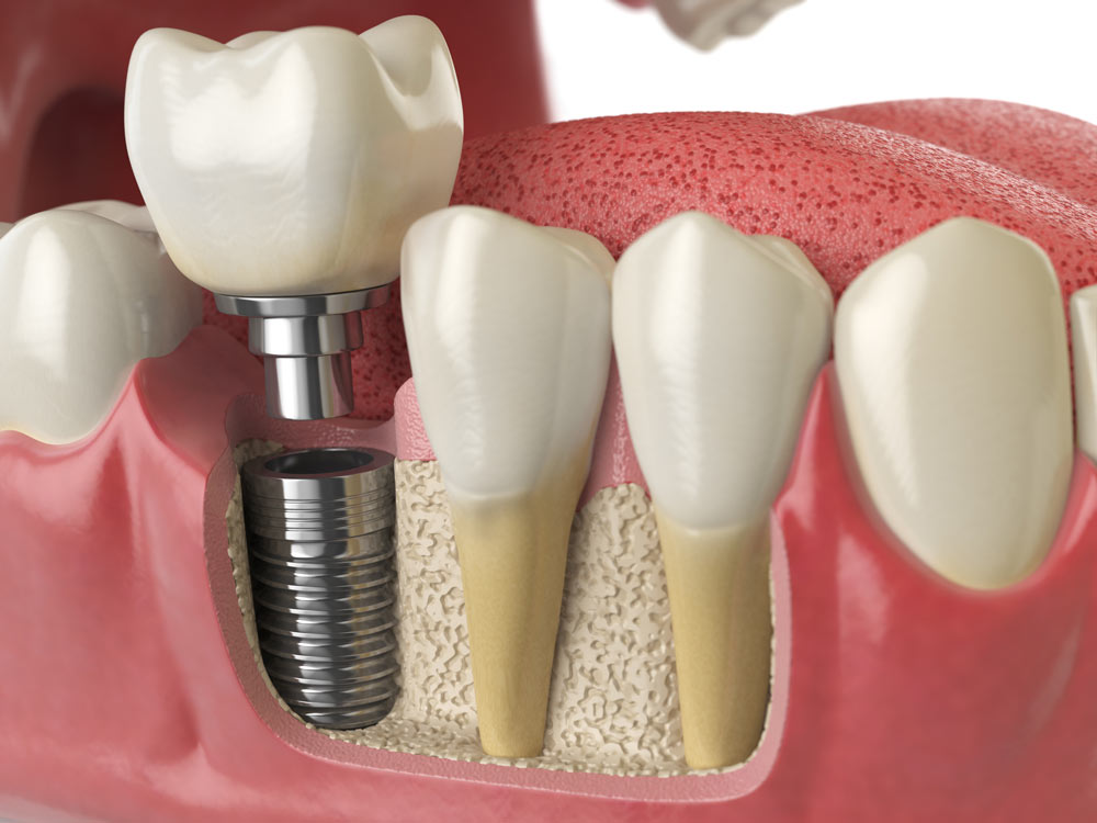 Implant Restorations